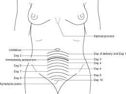 17 Methodical Fundal Height Postpartum