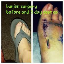 Bunion Surgery Before After Bunion Surgery Bunion Mens Flip Flop