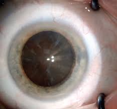 Image result for Cataract
