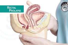 Image result for Rectal prolapse