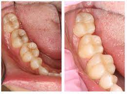 Soak a small piece of cotton in the oil, then blot the cotton on a piece of tissue to remove the excess. Treating Cavities In Kittanning Dental Crowns Voller Dentistry
