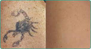 Professional tattooists apply design involving more profound skin layers at times. Single Colour Tattoo Removal North Bristol Nhs Trust