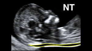 The nuchal testing has no effect on baby at the scan, all the sonographer does is test the amount of fluid behind babies neck, and you will have a special blood test done on teh same day as well, adnw ahtever the reading, you will be informed, and then again the decision is entirely yours to make. How To Perform Nuchal Translucency Scan Youtube