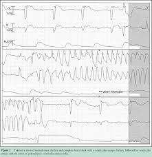 The first 2 sections, bradycardia and tachycardia, begin with evaluation and treatment and provide an overview of the information summarized in the acls bradycardia and tachycardia. From Bradycardia To Tachycardia Complete Heart Block Semantic Scholar