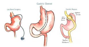 Who Is A Good Candidate For Gastric Sleeve Surgery