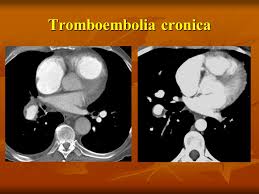 L'embolia polmonare, come già detto, consiste nella migrazione di una massa solida, liquida o gassosa in un vaso del circolo arterioso polmonare. Embolia Polmonare Acuta Angio Tc Ppt Scaricare