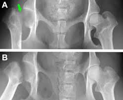 Legg Calve Perthes Disease In The Dog Sciencedirect