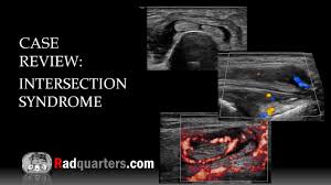 Image result for Intersection Syndrome