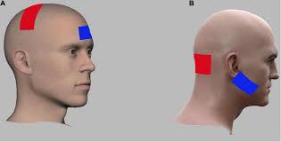 Electrode montages for anodal tran-scranial direct current stimulation...