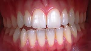 Image result for Gingivitis