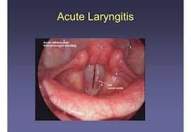 Image result for Acute Laryngitis