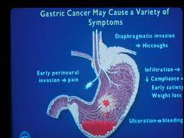 In most of the world, stomach cancers if you have signs and symptoms that worry you, make an appointment with your doctor. Gastric Cancer Cancer Therapy Advisor