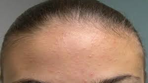 Como Quitar Los Granos De La Frente