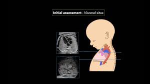 Fetal Echocardiography Protocol And Technique Youtube
