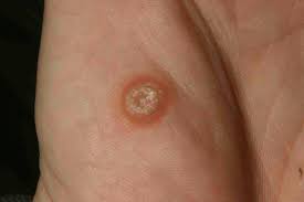 In this writing, learn how these conditions are similar as well as how they differ. Chapter 8 Skin Cancer 909