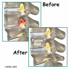 Pin On Spinal Fusion