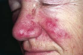 Image result for demodex rosacea
