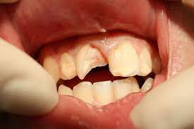 Chipped Tooth- How to Fix Broken Teeth Le Sueur-Le Sueur Family Dental