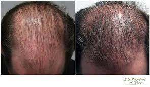 Maybe you would like to learn more about one of these? Non Surgical Hair Loss Therapy In Gilbert Az Gilbert Med Spa Serving Mesa Chandler Tempe
