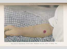 It laid the basis for inoculation against the disease. The Schick Test History Of Vaccines