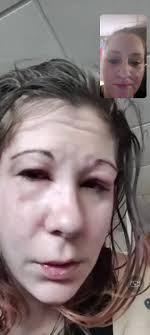 Hello, my name is Fatima. I'm from Ecuador. I'm 37 years old. I've had a  catastrophic illness since birth called BULLISH EPIDERMYOLYSIS, which makes  it impossible for me to work like a