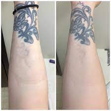 Pico lasers were initially used in tattoo removal, to optimize efficacy and reduce. One Year Difference I Only Had One Very Small Session In That Time On That Darker Stubborn Part The Rest Has All Faded On Its Own With Time And A Little Help