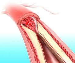 Image result for Hypercholesterolemia