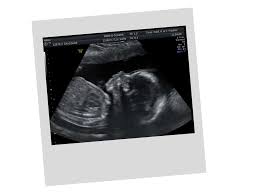 Wenn sie jedoch keine weiteren beschwerden haben, raten die meisten ärzte, ab der fünften schwangerschaftswoche (ssw) einen termin für die erste untersuchung zu machen. Schwangerschaft Frauenarztpraxis Dres Fischer Frauenheilkunde Geburtshilfe