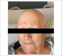 Your shorter hairs like eyelashes, arm and leg hair and eyebrows have a short anagen phase — about one month. Scalp Picture Showing Alopecia Figure 2 Picture Showing Hair Loss Of Download Scientific Diagram