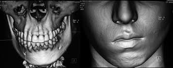 e Hard and soft tissue CT scan showing the nature of asymmetry.