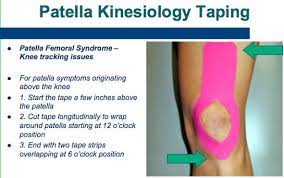Patellofemoral Pain Syndrome Exercises Treatment Plan