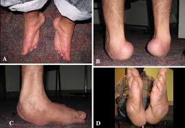 It results from structural defects of several tissues of foot and lower leg leading to abnormal positioning of foot and ankle joints. Case Report Correction Of Neglected Club Foot Deformity By Arthroscopic Assisted Triple Arthrodesis Springerlink