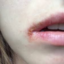 Image result for Angular Cheilitis