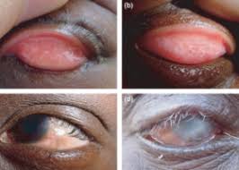 Image result for Chlamydia Trachomatis