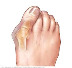 It often has no symptoms. Bunions Symptoms And Causes Mayo Clinic