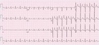If you have had a heart attack, your doctor will probably want you to take certain medicines for a long time. Sinus Tachycardia Wikipedia