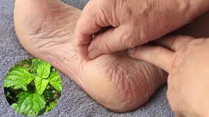 The leaves have been us as medicine to cure small wound. 3 Langkah Rebus Daun Kapal Terbang Untuk Turunkan Kencing Manis 17 9 Kepada 7 Maskulin