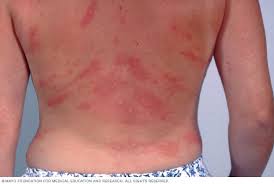 Symptoms include an itchy, stinging pink rash of slightly swollen skin. Chronic Hives Symptoms And Causes Mayo Clinic
