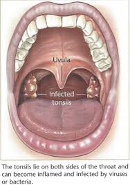 Maybe you would like to learn more about one of these? Tonsillectomy Tonsillitis Removal Surgery Melbourne Ent Group