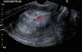 Endometrial cancer is detected at an early stage because it frequently produces abnormal vaginal bleeding. Endometrial Carcinoma In Premenopausal Woman Radiology Case Radiopaedia Org