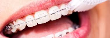 Kleinere korrekturen beginnen bei etwa 500 euro, eine festsitzende spange beginnt bei 1.500 euro und bei einem kiefergelenkdefekt geht es bei 6.000 euro los. Zahnspangen Hygiene Tipps Gegen Geruche Und Karies Dental One