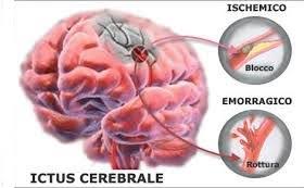 Per diagnosticare un'emorragia subaracnoidea, il medico valuta i sintomi e può prescrivere una serie di esami per determinare la. Vasculopatie Intracraniche Cliccascienze
