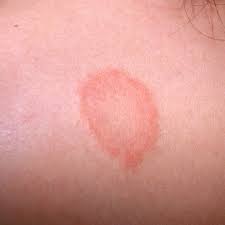 Ringworm In Babies And Children Babycenter The lesion caused by this infection resembles a worm in the shape of a ring ringworm is usually specifically used to describe tinea corporis (ringworm of the body), although it can sometimes be used to describe tinea infection. ringworm in babies and children