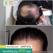 الحمدالله و التوفيق من رب العالمين الدكتور احمد سمرين لزراعة الشعر Facebook