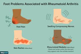 Out of everything on this list, this is probably the most visually apparent symptom of foot pain. Pain In The Feet As A Symptom Of Rheumatoid Arthritis