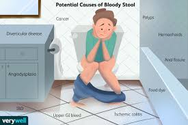 Image result for blood in stool human poop