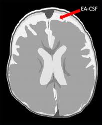 Image result for Hydrocephalus