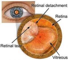 Dezlipirea De Retina Eye Retina Posterior Vitreous Detachment Detachment