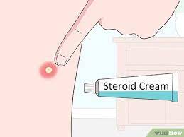 Disinfect the area or cleanse it well. 3 Ways To Remove An Ingrown Hair Wikihow