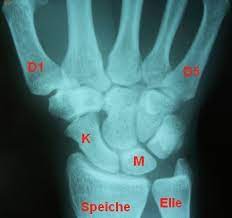 Haufige Fragen Bei Einem Handgelenks Bruch Handerkrankungen